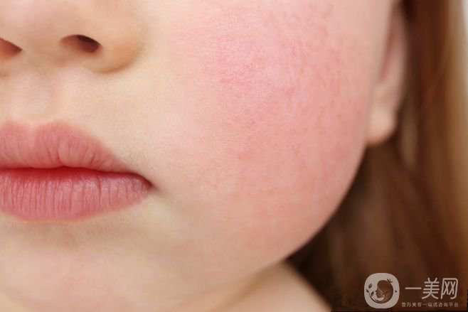 臉上很多紅血絲怎么辦？給你1個(gè)小法寶和紅血絲說(shuō)再見(jiàn)