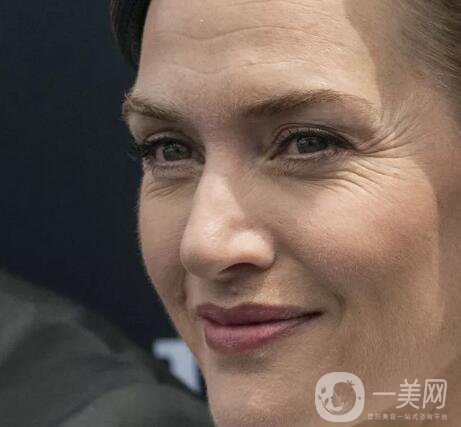 祛除眼角魚尾紋方法有哪些？價格一般是多少呢？