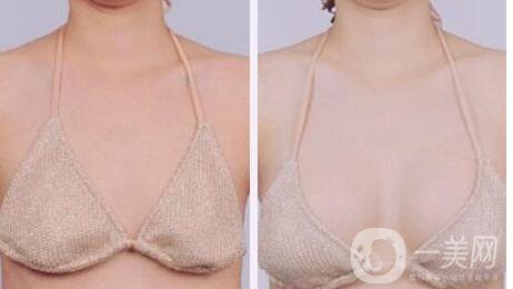妙桃假體豐胸價(jià)格 妙桃假體隆胸的優(yōu)點(diǎn)