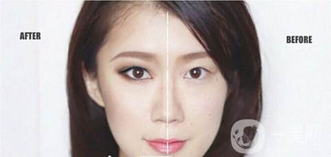 生物焊接雙眼皮價(jià)格 生物焊接雙眼皮術(shù)后護(hù)理