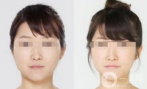 *要花多少錢 Botox的優(yōu)勢有哪些