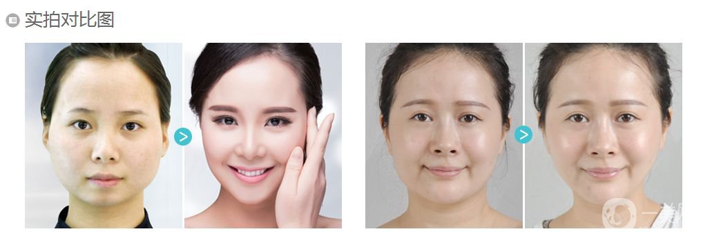 *要花多少錢 Botox的優(yōu)勢有哪些