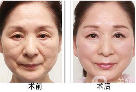 解放軍455整形外科隆胸手術(shù)做的怎么樣 