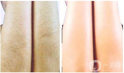 激光脫毛有什么好處？