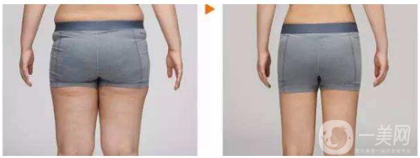 吸脂手術(shù)類型有哪些？