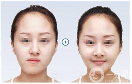 正頜手術(shù)的方法有哪些？