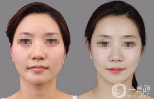 顴骨整形手術(shù)的方法有哪些？