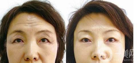 祛抬頭紋多少錢(qián) 去抬頭紋的方法