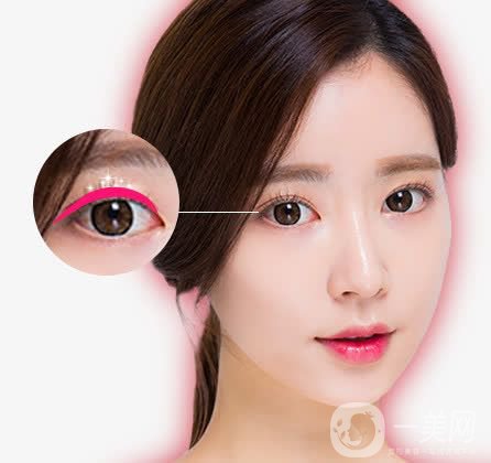 亞韓割雙眼皮多少錢？