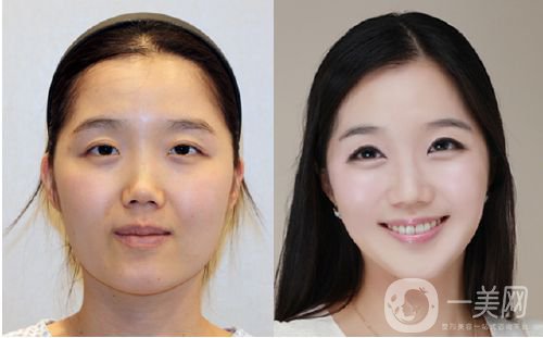 班加羅爾面部頸部抽脂術(shù)怎么樣 價格是多少？