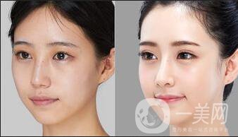 自體脂肪填充做幾次,自體脂肪填充*性