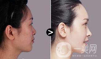 隆鼻多少錢,隆鼻術(shù)后注意事項(xiàng)