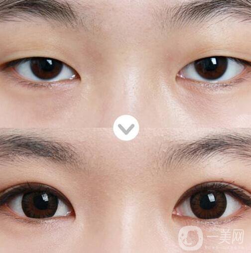 三點(diǎn)定位雙眼皮,三點(diǎn)定位雙眼皮眼睛疼嗎