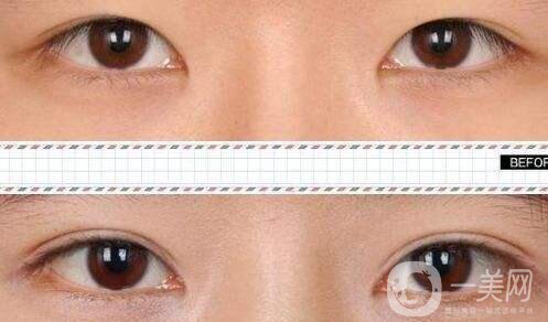 雙眼皮修復(fù)要多久,雙眼皮手術(shù)恢復(fù)時間