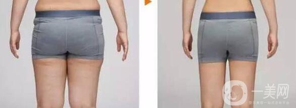 大腿吸脂多久恢復(fù),大腿吸脂*嗎