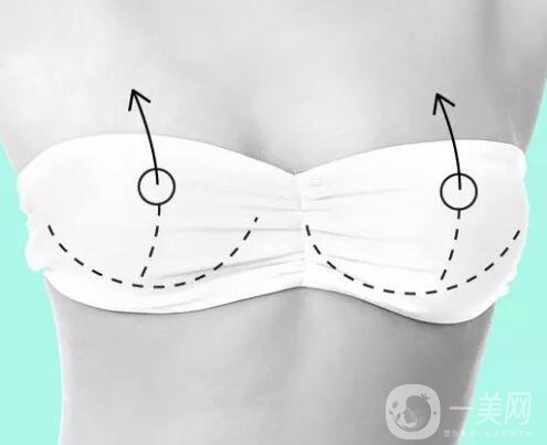 隆胸多少錢？術(shù)后有哪些注意事項？