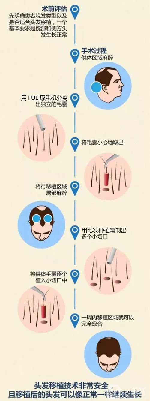 毛發(fā)移植*果怎么樣？毛發(fā)移植原理是什么？