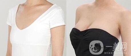 自體脂肪隆胸手術(shù)多少錢 *嗎？