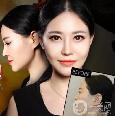 隆鼻手術(shù)一般多少錢？價格高不高？