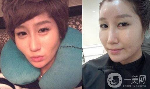 面部脂肪填充*果*嗎 注意事項(xiàng)有哪些