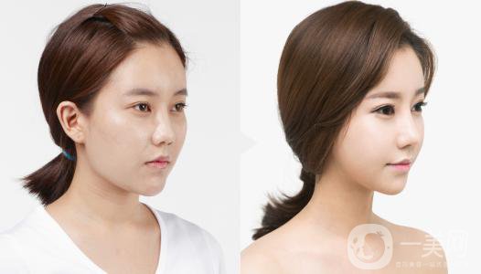 印度班加羅爾下巴整容手術(shù)費用 頜骨整容手術(shù)*果