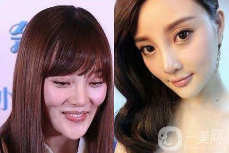 又一個整容失敗的女明星，鼻子都整歪了，不甘心揚言還要植發(fā)！