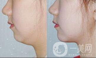深圳雙下巴吸脂價格,雙下巴吸脂多久恢復(fù)