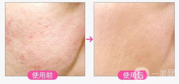 彩光祛痘印前后 彩光祛痘*果怎么樣 會(huì)復(fù)發(fā)嗎？	
