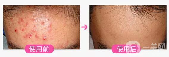 彩光祛痘印前后 彩光祛痘*果怎么樣 會(huì)復(fù)發(fā)嗎？	