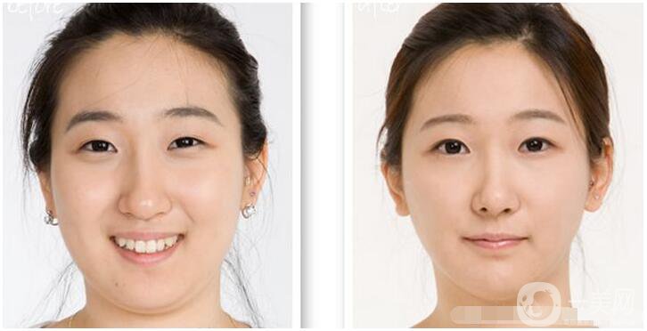 什么是雙下巴手術(shù)？術(shù)前需要準(zhǔn)備什么？