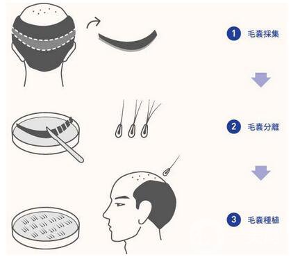 FUE毛發(fā)移植技術(shù)好嗎?