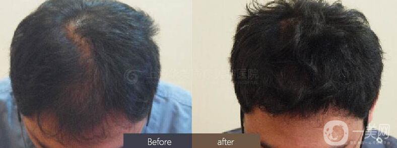 FUE毛發(fā)移植風(fēng)險(xiǎn)