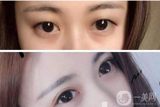 雙眼皮術(shù)后注意事項