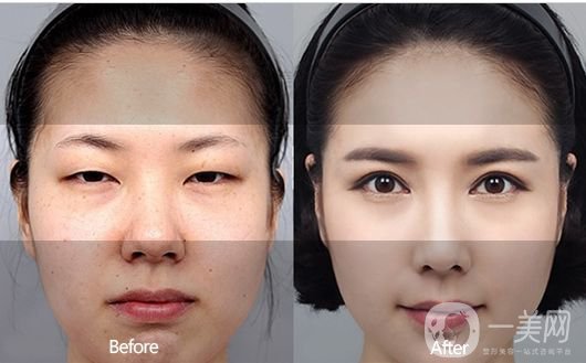 一般割雙眼皮多少錢？影響價(jià)格的因素有哪些？