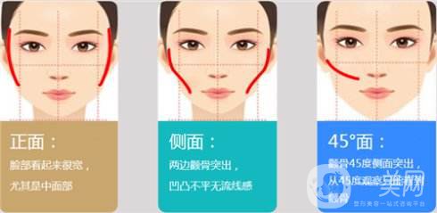 面部磨顴骨術(shù)后恢復(fù)要多久 磨顴骨*嗎