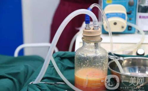 “吸脂減肥"手術(shù)前，你需要知道這些小常識 