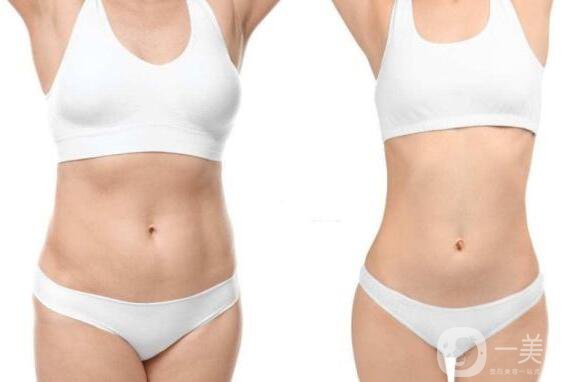 為什么抽脂如此*?抽脂有什么風(fēng)險?