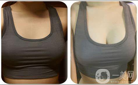 隆胸手術(shù)后應(yīng)該注意什么？如何護(hù)理？