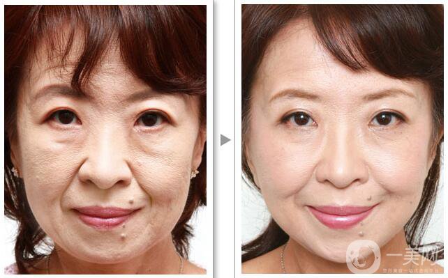 注射*有什么并發(fā)癥和副作用嗎？