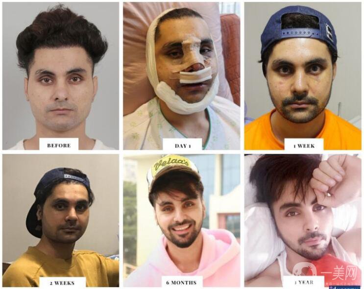 面部輪廓手術(shù)的恢復(fù)時(shí)間及注意事項(xiàng)講解