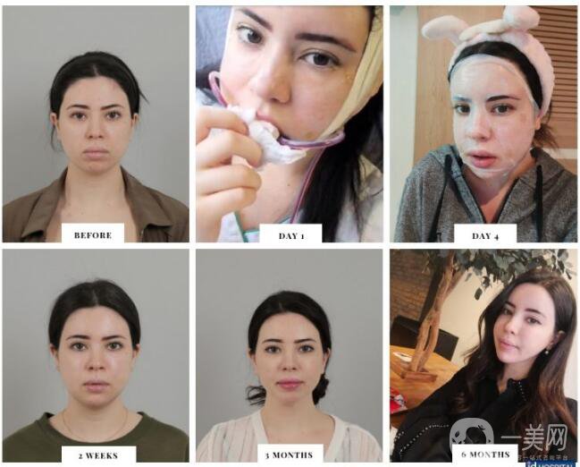 面部輪廓手術(shù)的恢復(fù)時(shí)間及注意事項(xiàng)講解