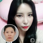 鼻部手術+雙眼皮手術術后恢復日記