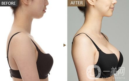 隆胸的材料有哪些？手術(shù)方式有哪些呢？】