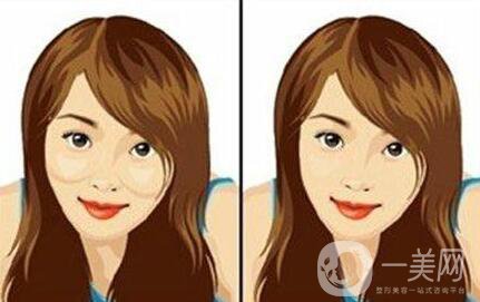 磨顴骨優(yōu)缺點有哪些 磨顴骨的*果自然嗎