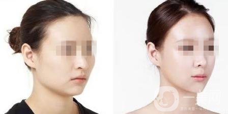 磨顴骨優(yōu)缺點有哪些 磨顴骨的*果自然嗎