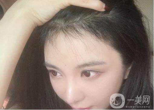 做*植發(fā)要多少錢(qián) 做*植發(fā)好不好