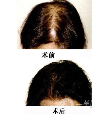 做*植發(fā)要多少錢(qián) 做*植發(fā)好不好