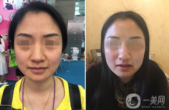 到底哪種面部提升手術適合你？