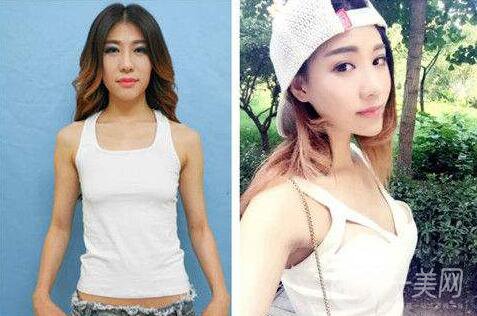 隆胸后出現(xiàn)哪些情況需要做修復？