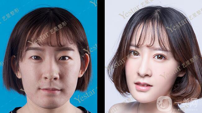 *前后 *手術(shù)*果如何？